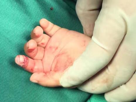 你相信嗎？兔子能把手指給咬斷了！