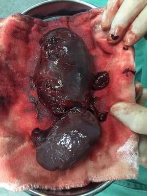 14歲男孩玩耍摔倒，脾臟破裂，險(xiǎn)些喪命！