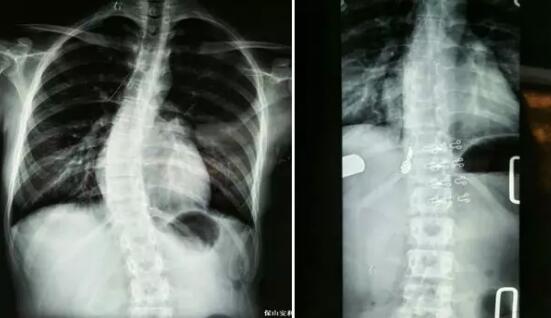 好好的脊柱怎么說彎就彎了？你竟然都沒發(fā)現(xiàn)……