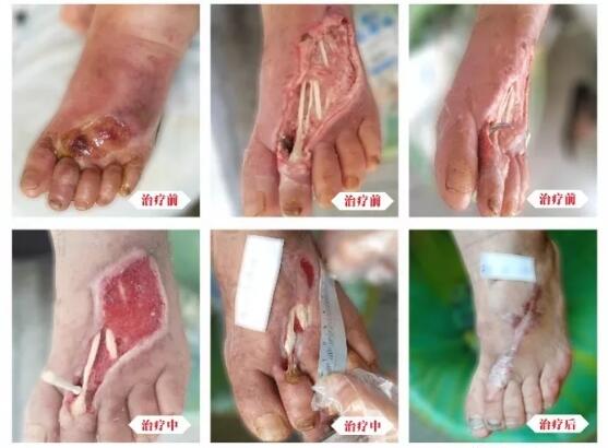 糖尿病并發(fā)癥有多可怕，及時治療糖尿病足避免截肢！
