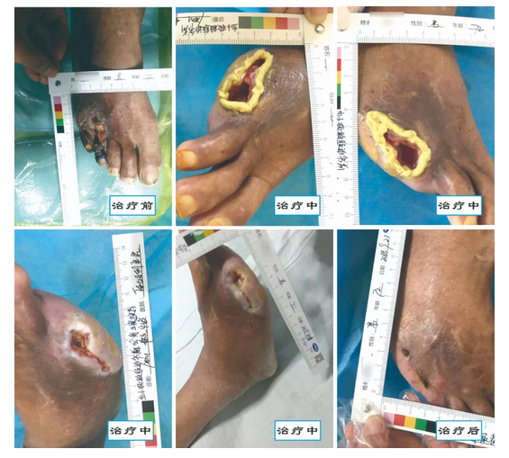 介入治療糖尿病足，您聽(tīng)說(shuō)過(guò)沒(méi)？