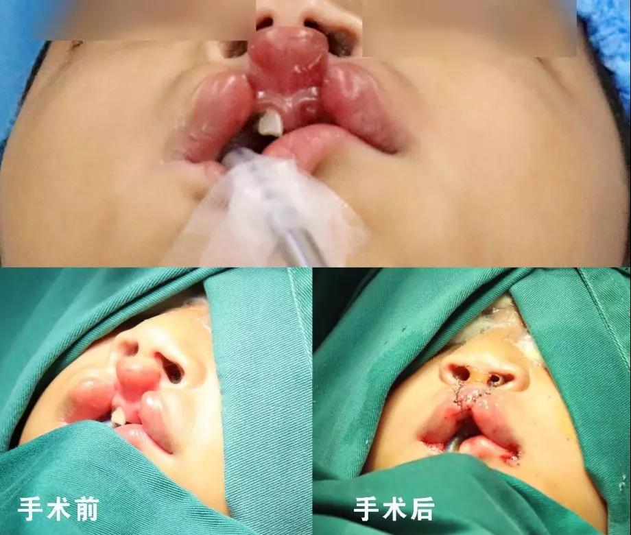 唇腭裂盡早治療消除孩子自卑心理，快樂成長(zhǎng)！