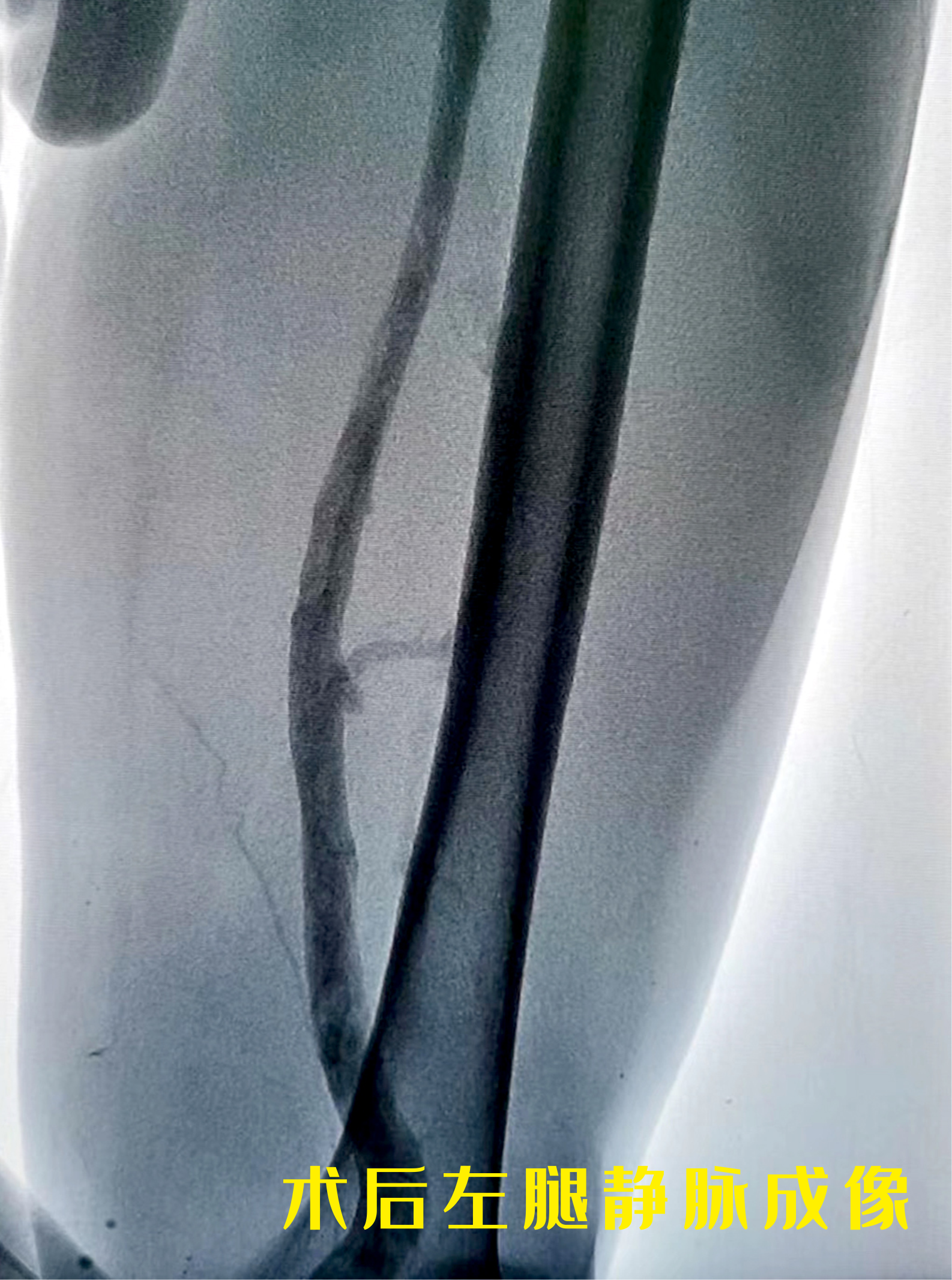 72歲老人，30年靜脈曲張，突發(fā)疼痛住院竟演變成了血栓！