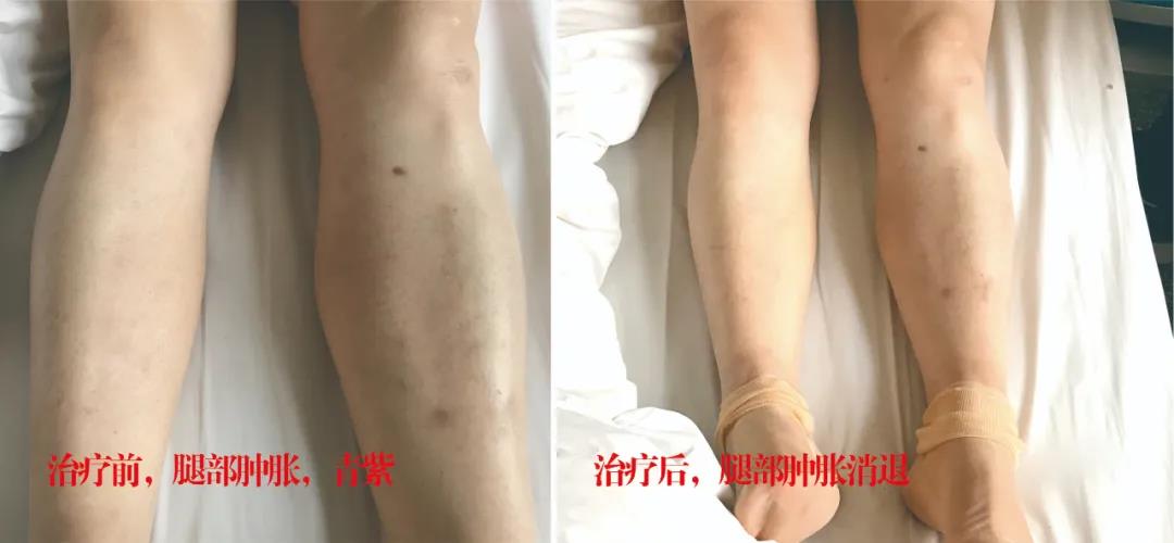 下肢靜脈血栓多年頑疾反復(fù)腫痛——疾病不容等待，早治療，早健康！