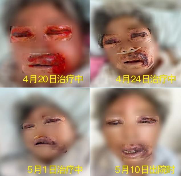 膿毒血癥（急性頜面部蜂窩組織炎）多學(xué)科聯(lián)合會診，幫助患者成功治愈！