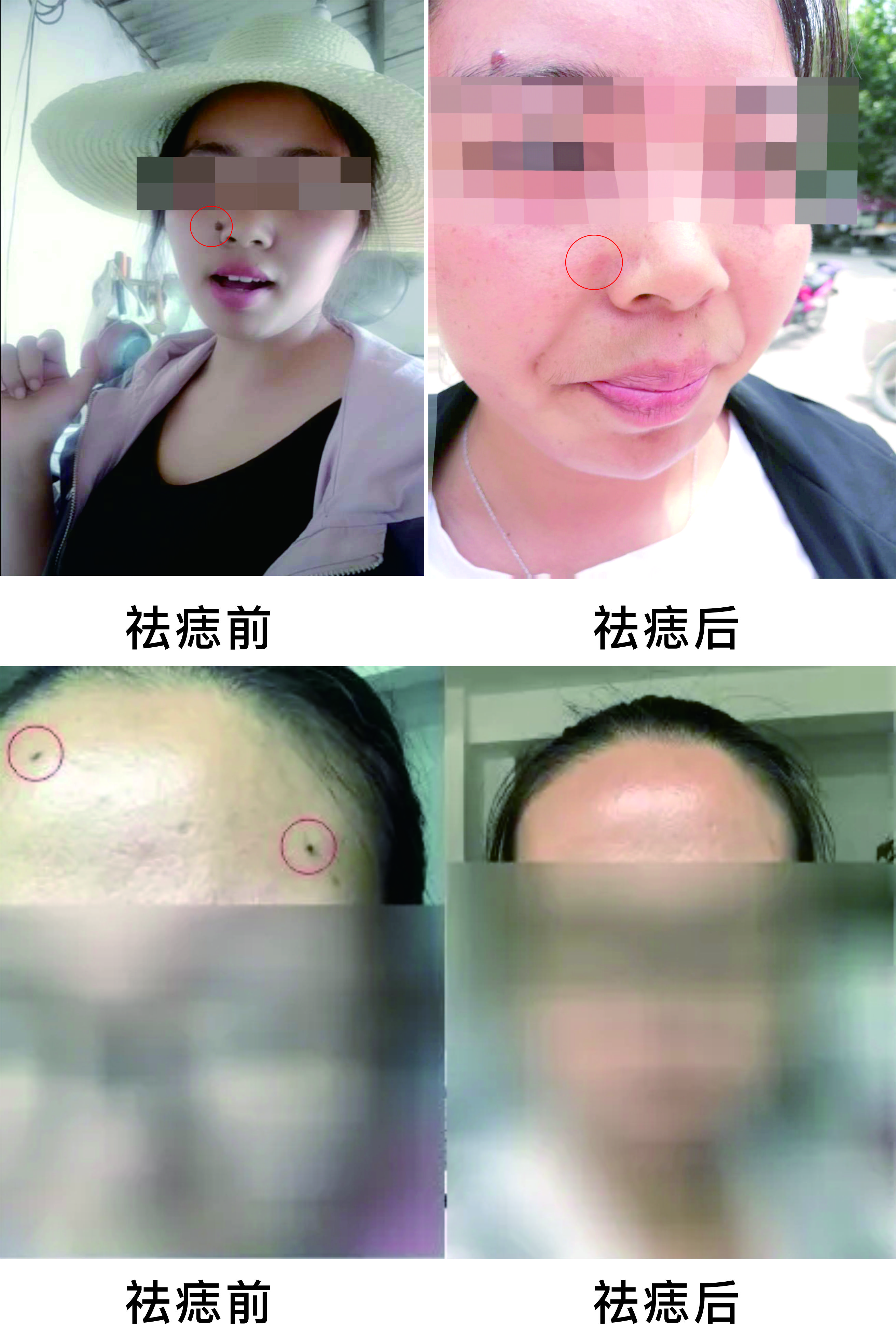 微波祛痣，告別臉部多余的“點(diǎn)綴”~