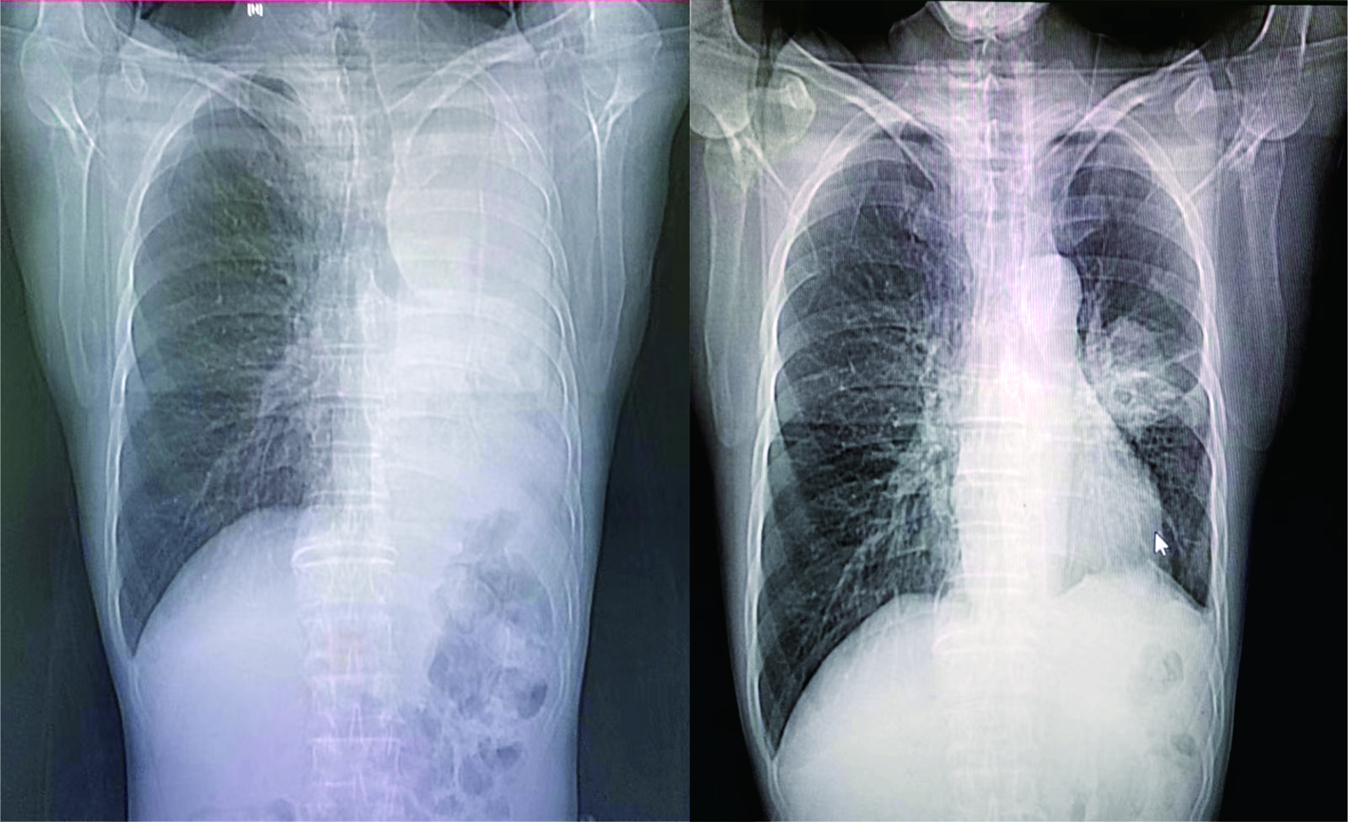 肺鱗癌IV期，首次化療一周期后胸部CT對(duì)比驚人！