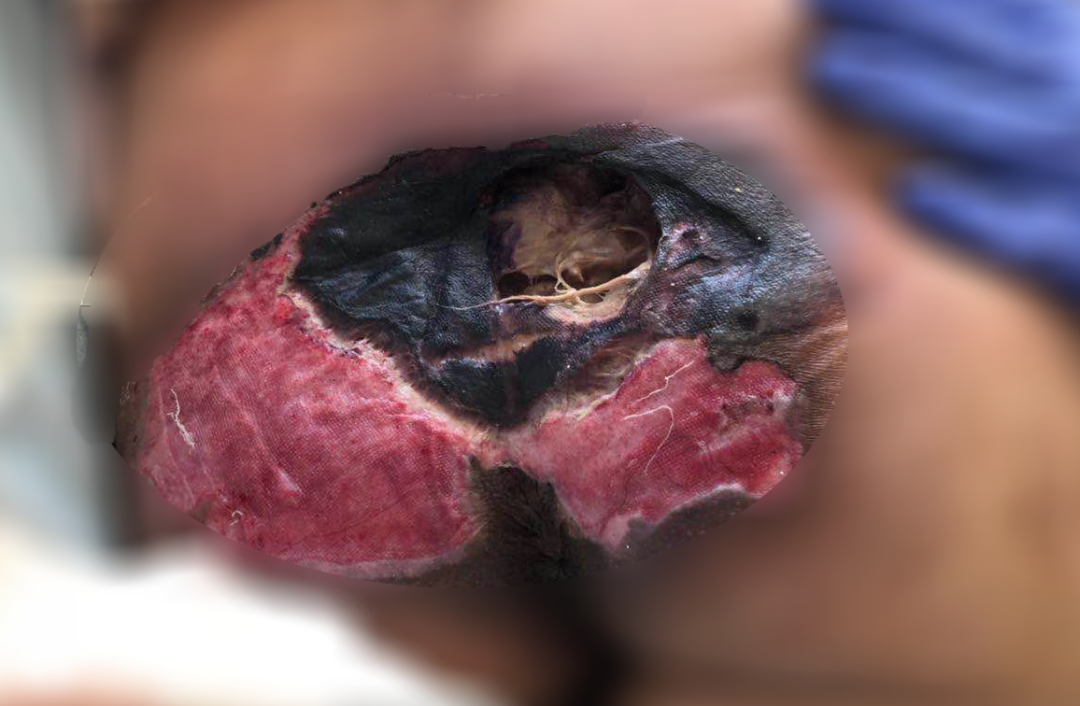 癱瘓3年的女患者臀部居然變成這樣?！