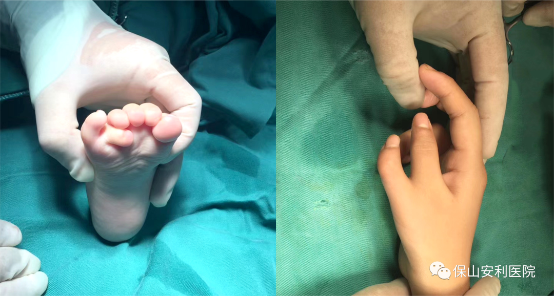 孩子先天手足多指（趾）不要慌，外二科幫你解除困擾！