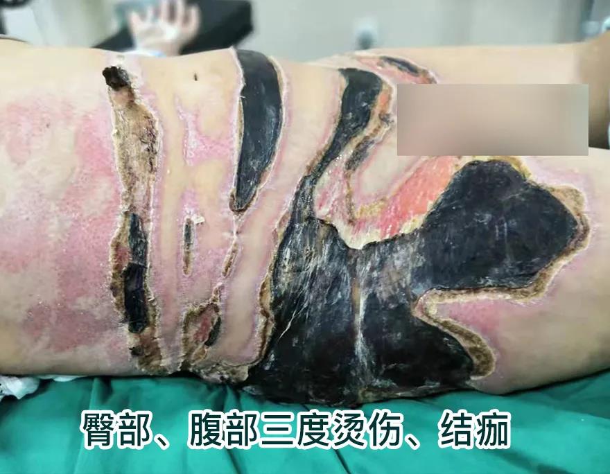 【保山安利醫(yī)院】80歲老人不慎燒傷，導(dǎo)致腹部、右側(cè)臀部大面積創(chuàng)傷，經(jīng)植皮治療創(chuàng)面逐漸愈合