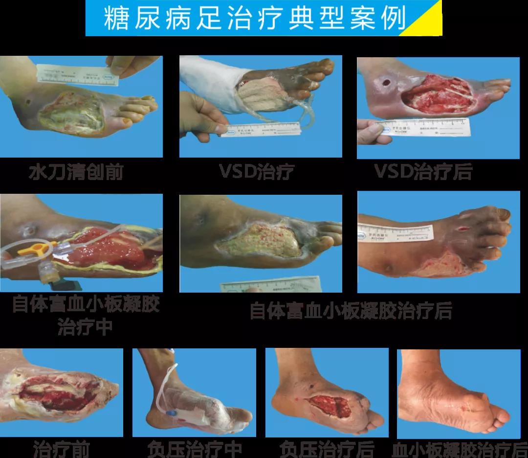 截肢、失明，甚至……，我們要做的是將糖尿病并發(fā)癥遏制在搖籃里！