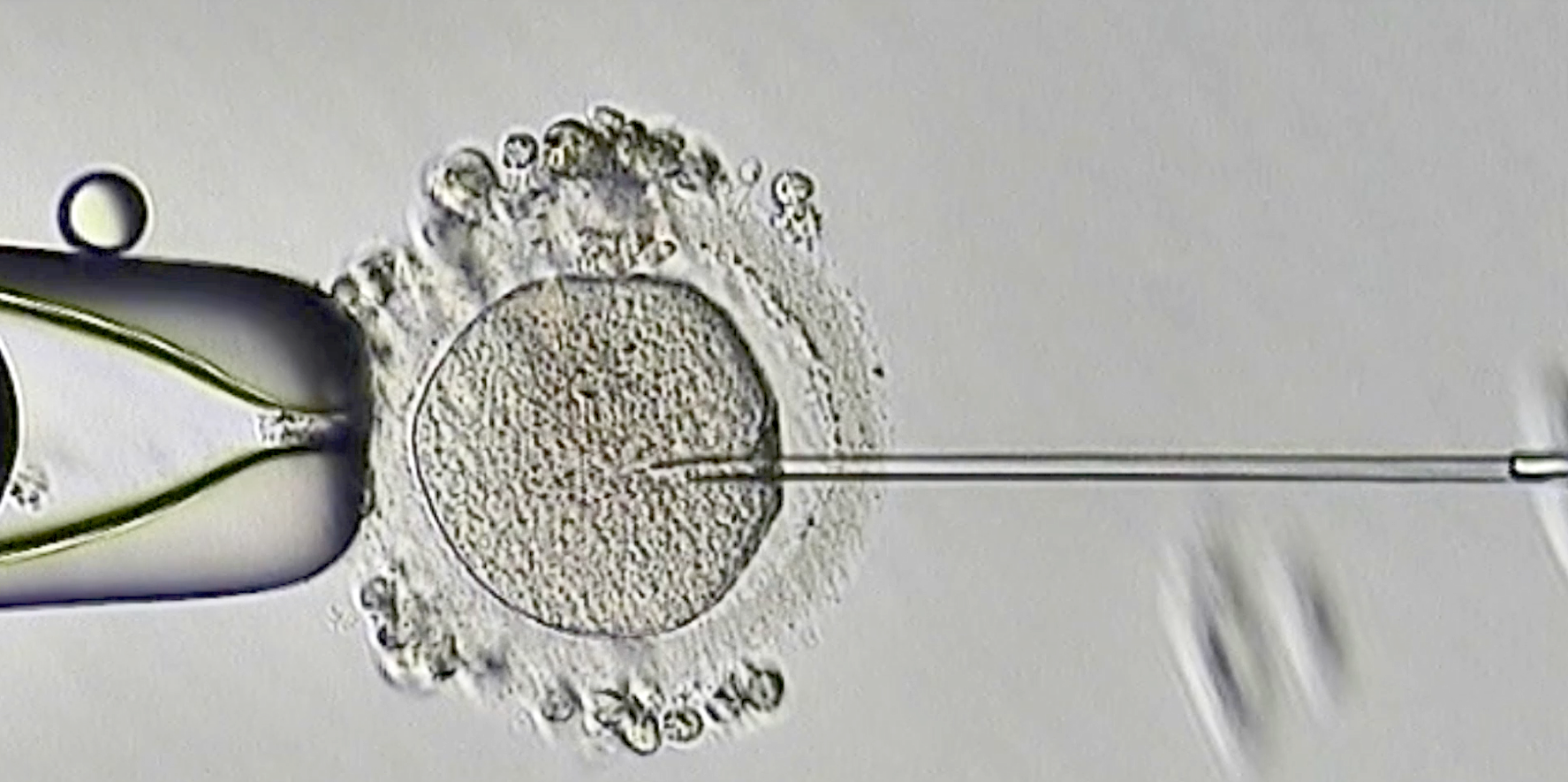 【喜訊】保山首例無精子癥通過試管嬰兒技術(shù)助孕成功！