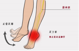 【保山安利醫(yī)院—健康科普】什么是足下垂！你了解嗎？