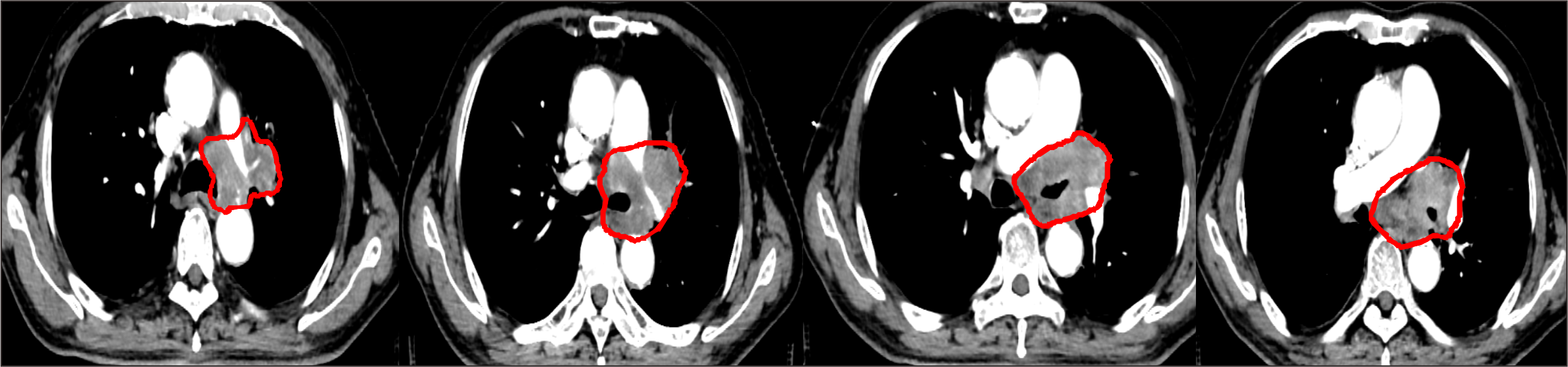 【保山安利醫(yī)院】對(duì)于局部晚期非小細(xì)胞肺癌患者，手術(shù)不能做，化療打不動(dòng)，該怎么辦？