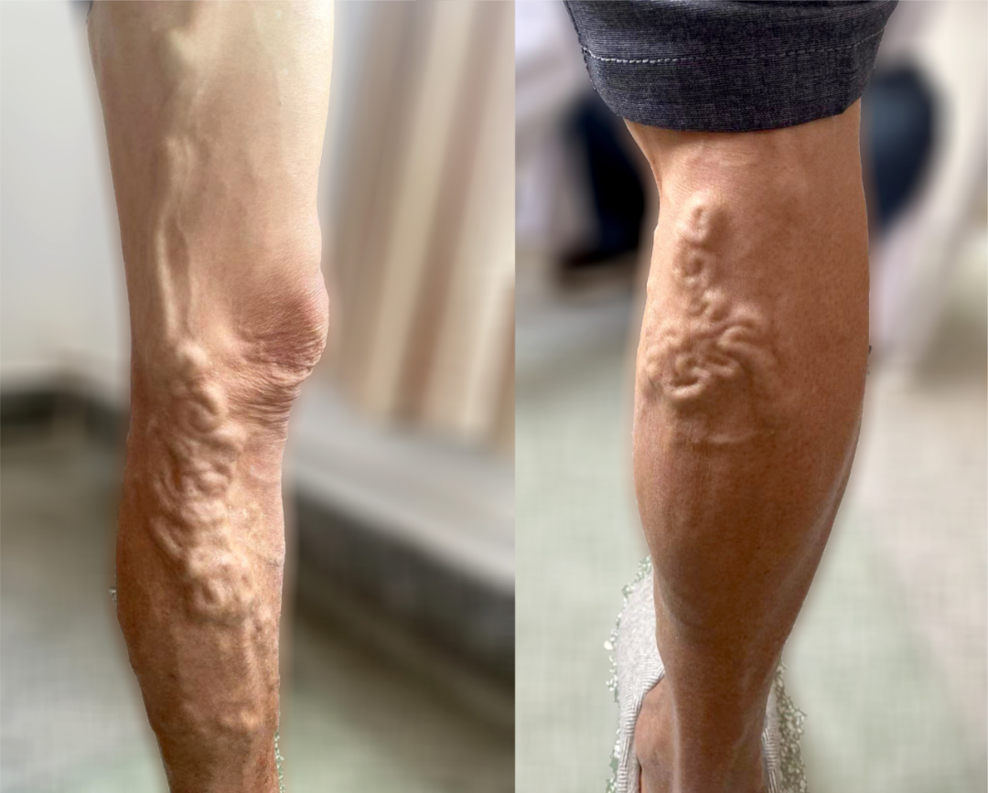 【保山安利醫(yī)院】大隱靜脈高位結(jié)扎＋剝脫術(shù)幫你解決大隱靜脈曲張“蚯蚓狀”紋路腿！