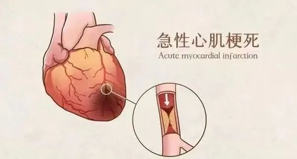【保山安利醫(yī)院】11月20日“心梗救治日” 時間就是心肌，時間就是生命！