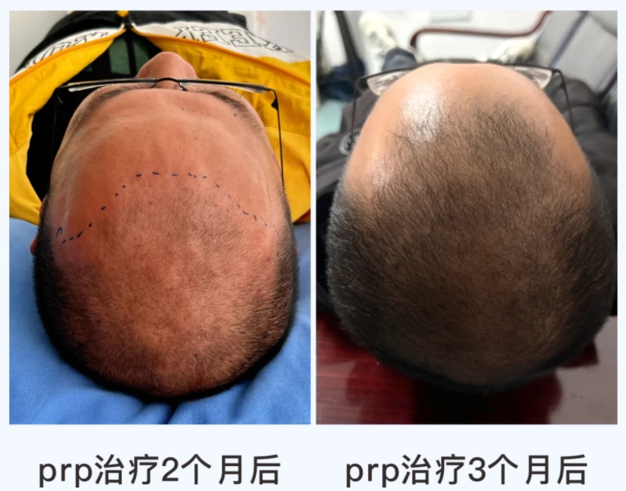 “我的頭發(fā)長(zhǎng)出來(lái)了”——自體富血小板血漿（PRP）治療脫發(fā)